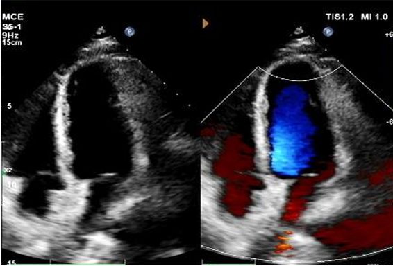 Case Sharing | Long-Tunnel PFO Closure with MemoSorb Biodegradable Occluder