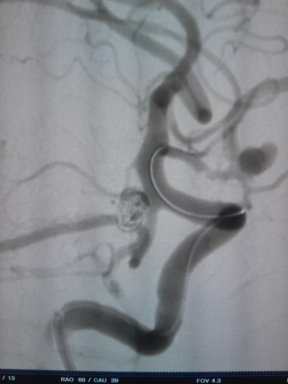 Clinical Spotlight | Multi-Aneurysm Treatment with Nuva® Flow Diverter and Perdenser® Embolic Coil System