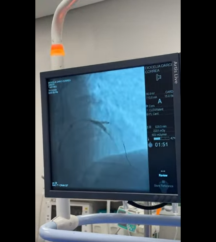 Case from Brazil: Kissing Balloon Technique with Vesselin DCB