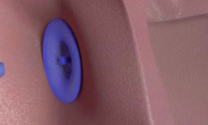 MemoSorb® Biodegradable Patent Foramen Ovale (PFO) Occluder obtained NMPA approval