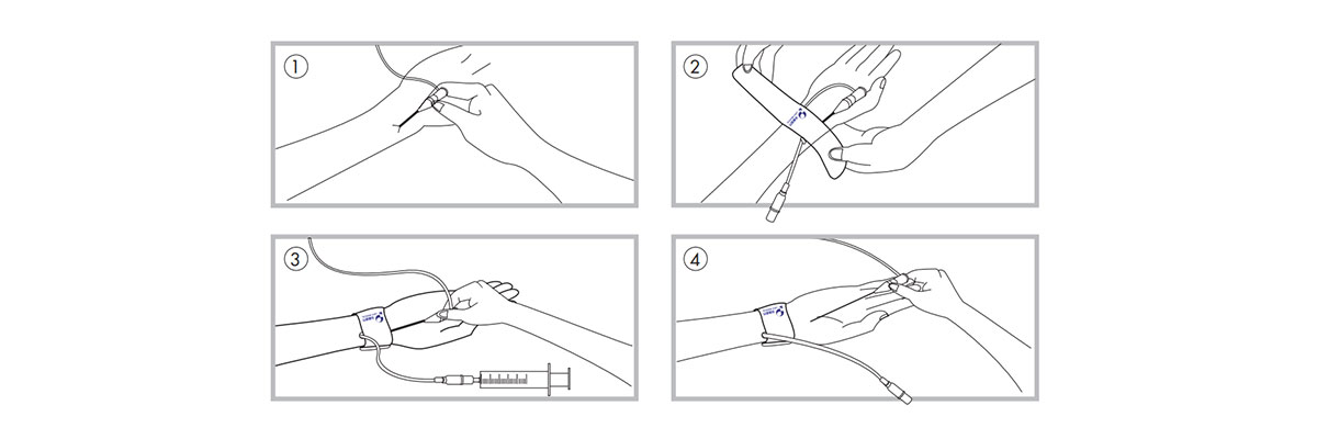 Radial Artery Compression Tourniquet Radial Artery Compression Tourniquet