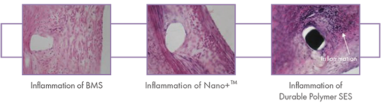 Polymer Free Stent Polymer Free Stent