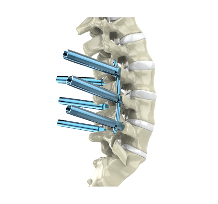 Product features Hard screw tail design, offer clear view during the surgery