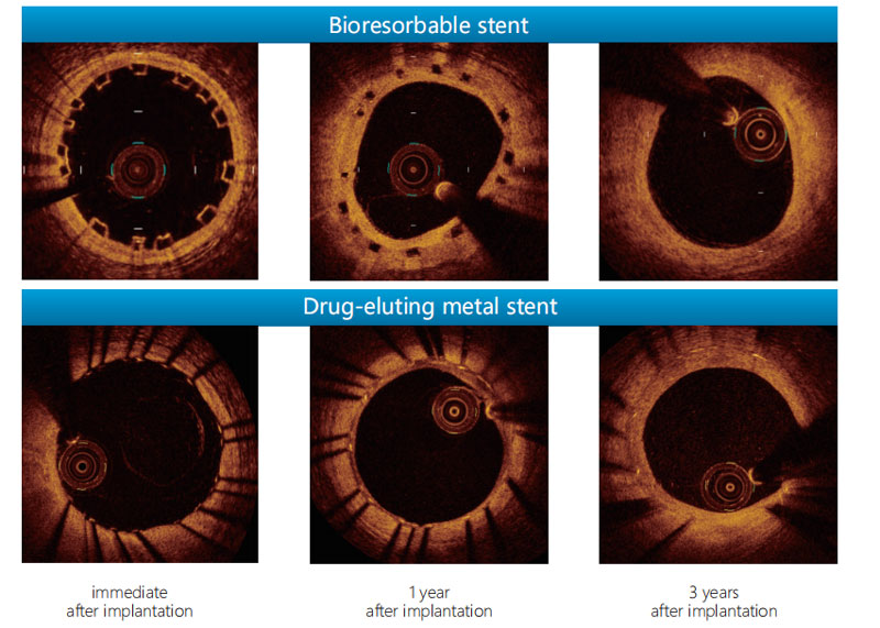 Lepu Medical NeoVas Sirolimus Eluting Coronary Stent Sirolimus