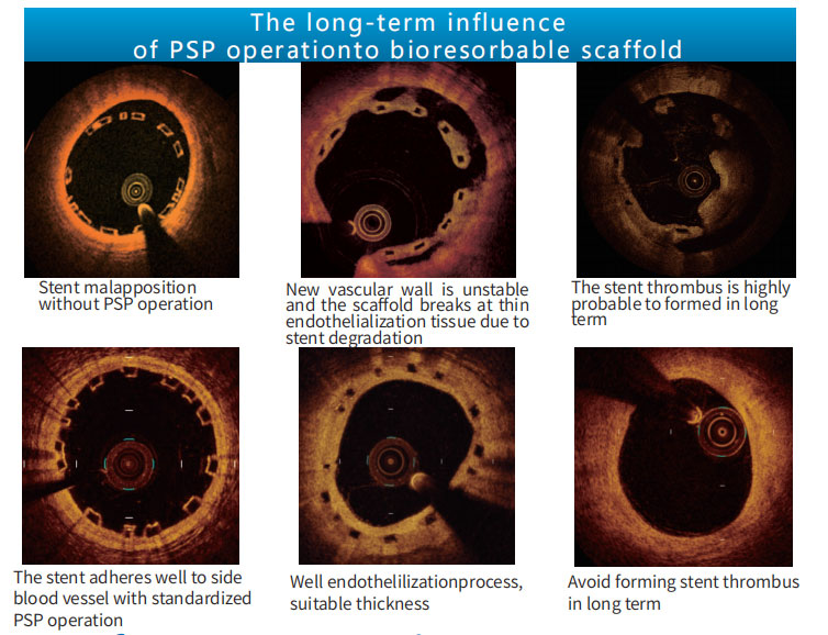 Stent Sirolimus