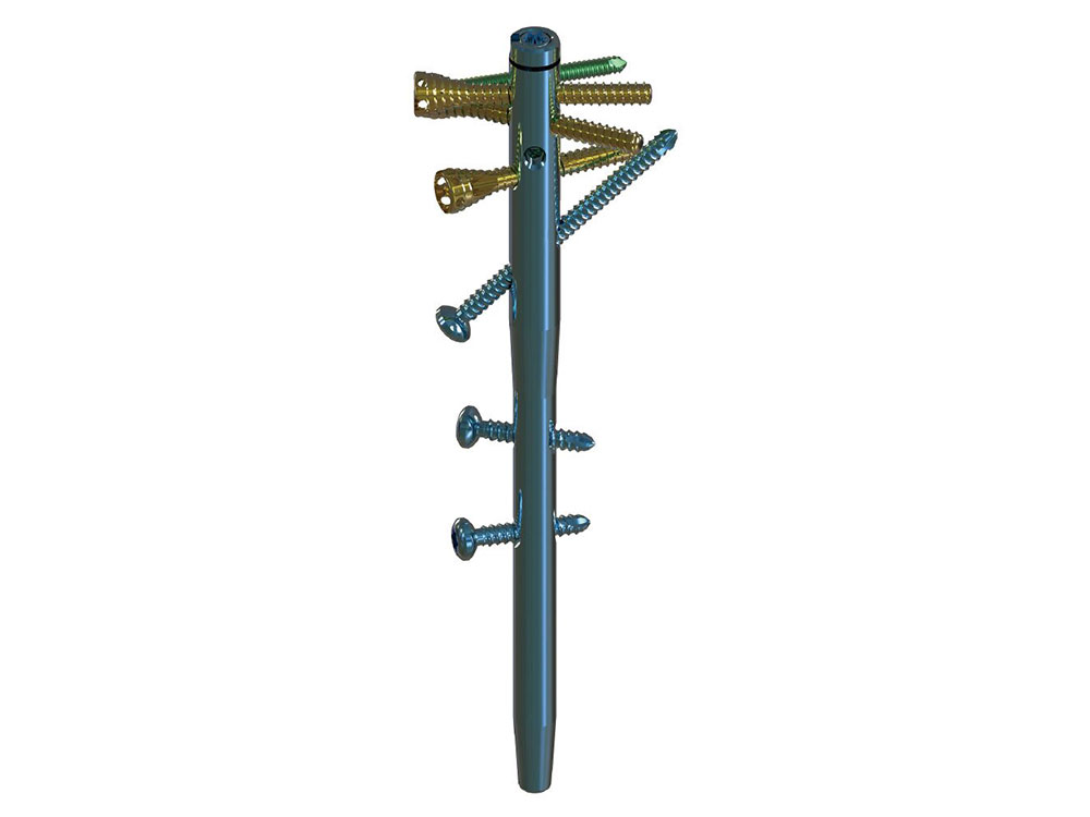 Humeral Interlocking Nail