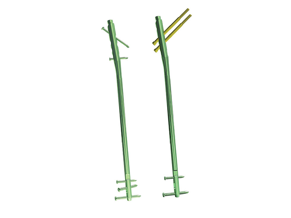Femoral Reconstruction Interlocking Nail (II)