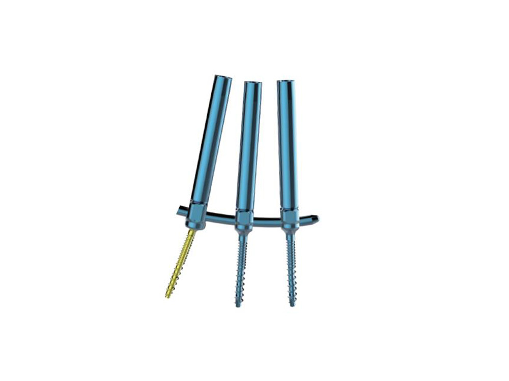 Posterior Spinal Internal Fixation (IX)