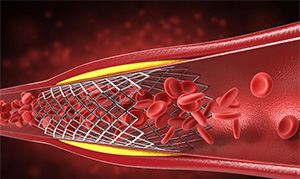 Types and Performance Characteristics of Dialyzer